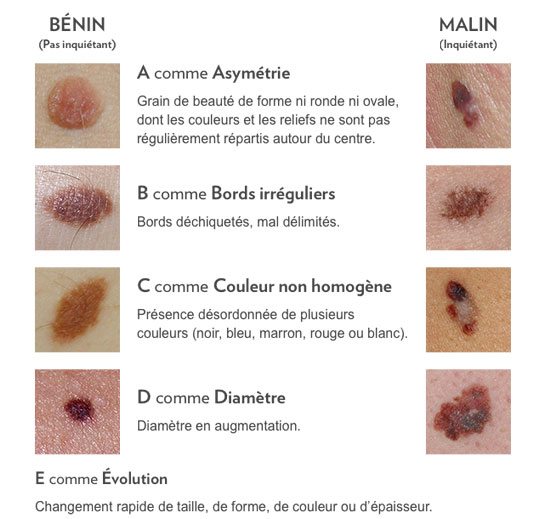 Typologie de grains de beauté