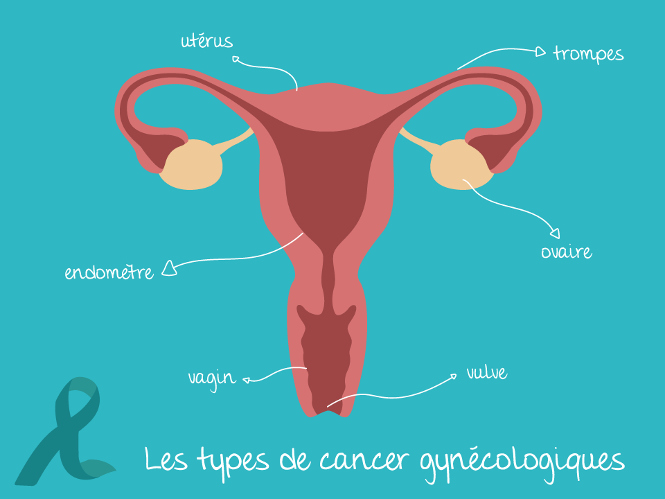 cancers féminins, gynécologie, cancérologie